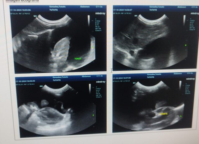Thoracic ultrasound showing pleural effusion